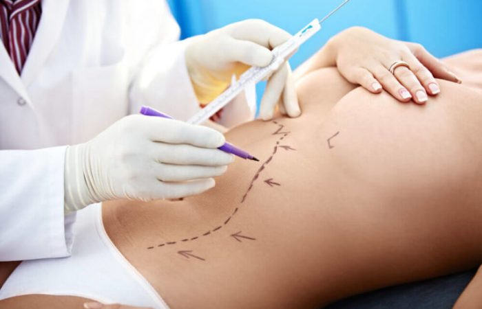 Mamoplastia Redutora – O que acontece durante a cirurgia?