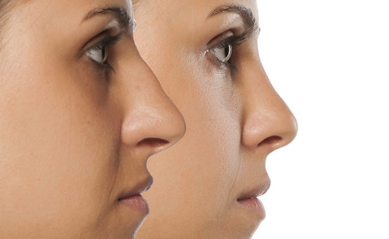 Rinoplastia: você está incomodado(a) com seu nariz? | Fontana Della  Gioventú Cirurgia Plástica