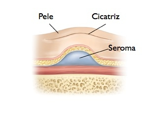 Seroma: o que é, sintomas, causas e tratamento - Tua Saúde