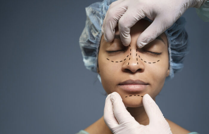 Alectomia Nasal: Aperfeiçoando a Harmonia Facial através da Redução das Asas Nasais