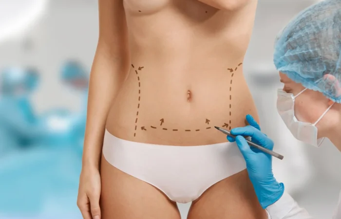Miniabdominoplastia: Indicação, Diferenças e Resultados da Cirurgia