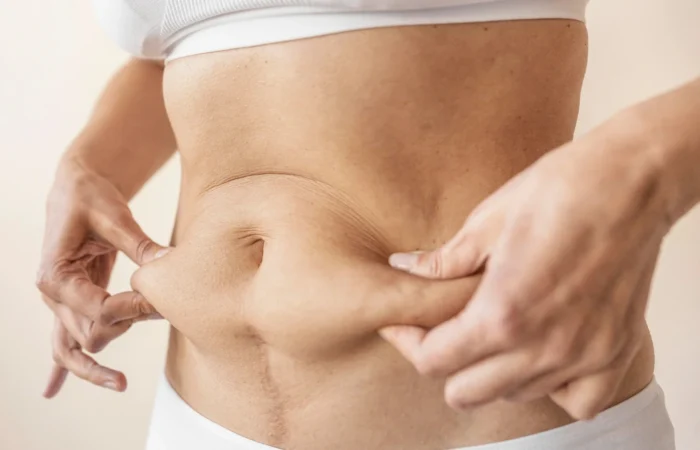 Abdominoplastia Circunferencial: transformação em 360°