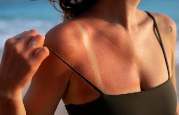 Por que não é indicado tomar sol após uma cirurgia plástica?