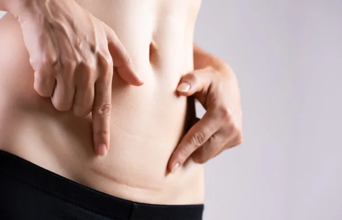 Cuidados com a cicatriz no verão: como garantir uma boa recuperação