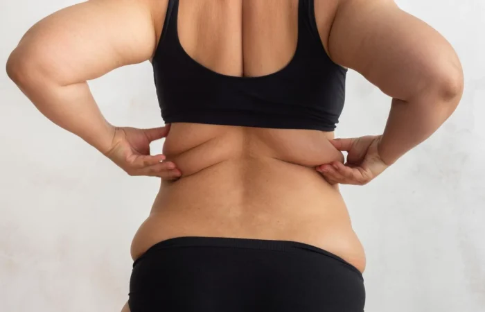 Torsoplastia: o que é, para quem é indicada e como funciona a cirurgia