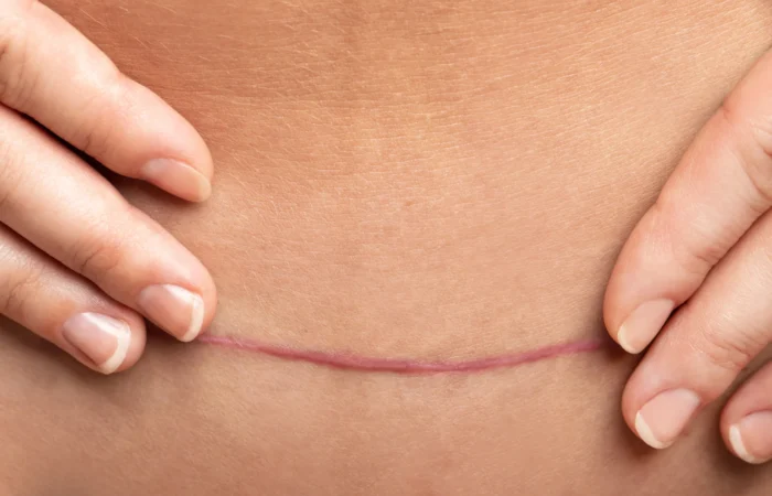 Cicatrização na cirurgia plástica: o que realmente influencia no resultado final?